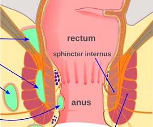 Anal Abcess Surgery Sydney Surgeon